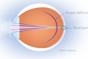 MiSight_technology